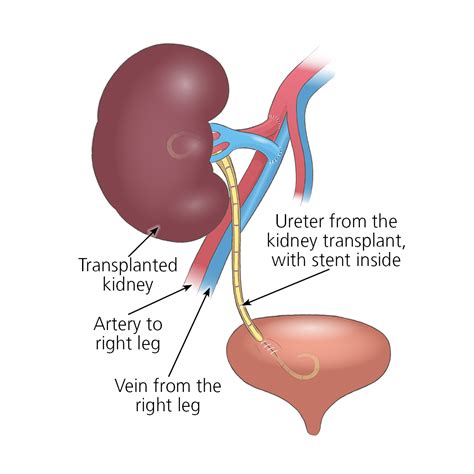 Full Drug Information. . Adderall after kidney transplant